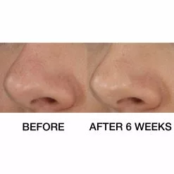 Clinique Blackhead Solutions Self-Heating Blackhead Extractor 11 Clinique Blackhead Solutions Self-Heating Blackhead Extractor -Clinique Sales global images 020714817909 4