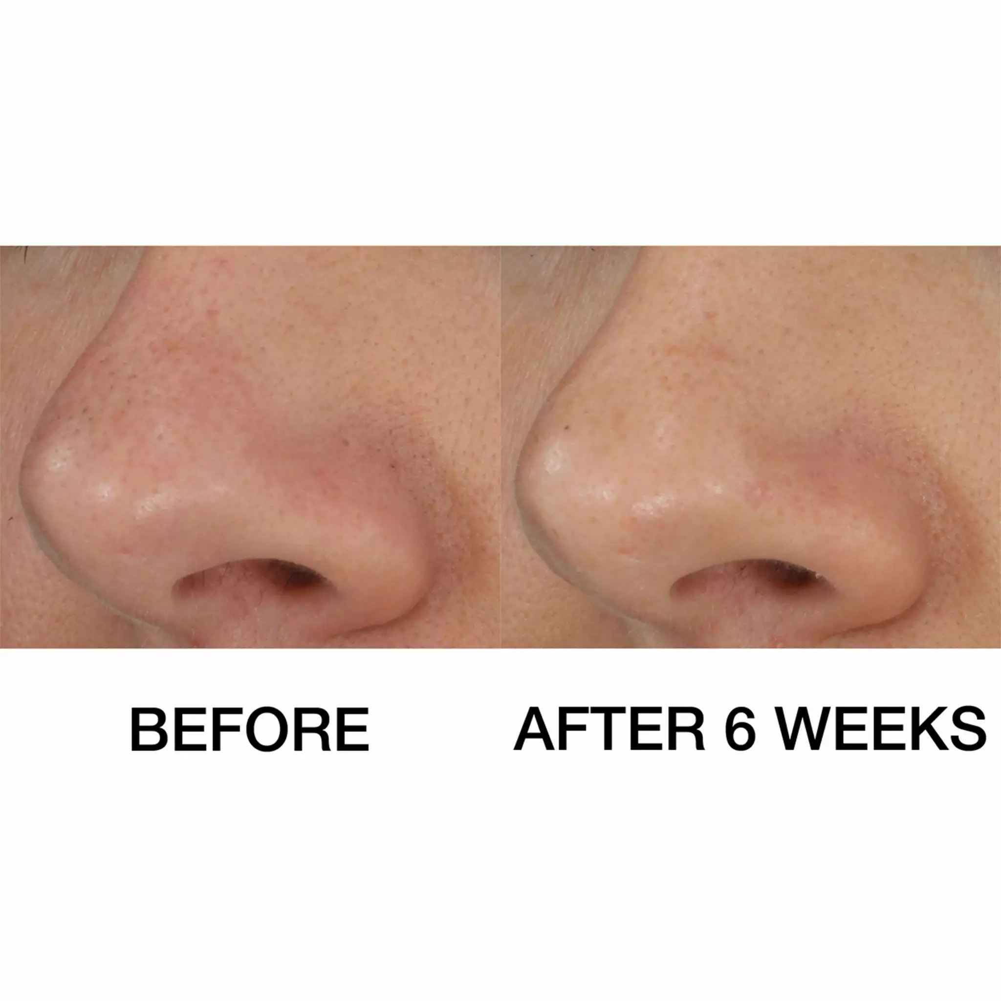 Clinique Blackhead Solutions Self-Heating Blackhead Extractor 6 Clinique Blackhead Solutions Self-Heating Blackhead Extractor - Image 4